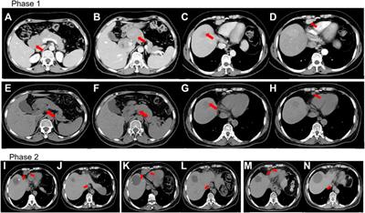 Case report: Immunotherapy plus chemotherapy and stereotactic ablative radiotherapy (ICSABR): a novel treatment combination for Epstein-Barr virus-associated lymphoepithelioma-like intrahepatic cholangiocarcinoma